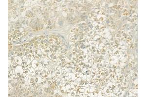ABIN6256934 and ABIN6274825 at 1/100 staining human hepatocellular carcinoma by IHC-P.