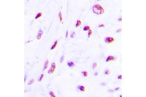 Immunohistochemical analysis of C/EBP beta (pT235) staining in human lung cancer formalin fixed paraffin embedded tissue section.