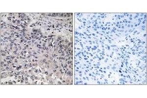 Immunohistochemistry analysis of paraffin-embedded human lung carcinoma tissue, using C1QC Antibody. (C1QC anticorps  (AA 81-130))