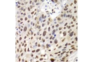 Immunohistochemistry of paraffin-embedded human lung cancer using GNB2L1 antibody (ABIN6292957) at dilution of 1:100 (40x lens).