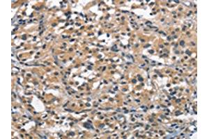 The image on the left is immunohistochemistry of paraffin-embedded Human thyroid cancer tissue using ABIN7189631(ACPT Antibody) at dilution 1/30, on the right is treated with synthetic peptide. (Testicular Acid Phosphatase (ACP4) anticorps)
