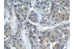 Immunohistochemistry analyzes of Op18 antibody in paraffin-embedded human breast carcinoma tissue. (Stathmin 1 anticorps)