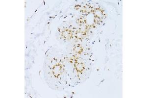 Immunohistochemistry of paraffin-embedded human breast using ZEB2 antibody (ABIN5973336) at dilution of 1/100 (40x lens). (ZEB2 anticorps)