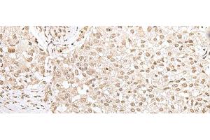 Immunohistochemistry of paraffin-embedded Human lung cancer tissue using ZKSCAN3 Polyclonal Antibody at dilution of 1:50(x200) (ZKSCAN3 anticorps)