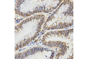 Immunohistochemistry of paraffin-embedded human rectal cancer using TPM2 antibody (ABIN5971583) at dilution of 1/200 (40x lens).