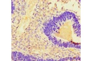 Immunohistochemistry of paraffin-embedded human ovarian cancer using ABIN7173135 at dilution of 1:100
