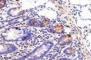 Immunohistochemistry analysis of paraffin-embedded human colon cancer using MIIP (ABIN7074626) at dilution of 1: 1200 (MIIP anticorps)