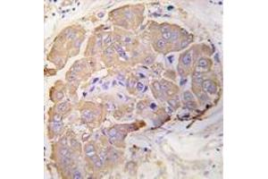 Formalin-fixed and paraffin-embedded human breast carcinoma tissue reacted with HSPB1 Antibody , which was peroxidase-conjugated to the secondary antibody, followed by DAB staining. (HSP27 anticorps  (Ser82))