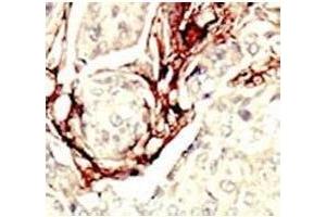 IHC analysis of FFPE human breast carcinoma tissue stained with the LKB1 antibody (LKB1 anticorps  (AA 14-44))