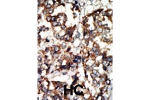 Formalin-fixed and paraffin-embedded human cancer tissue reacted with the primary antibody, which was peroxidase-conjugated to the secondary antibody, followed by DAB staining.