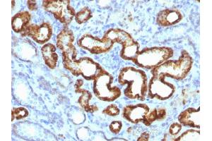 Formalin-fixed, paraffin-embedded human prostate carcinoma (20X) stained with AMACR / p504S Rabbit Monoclonal Antibody (13H4) (AMACR anticorps)