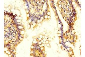Immunohistochemistry of paraffin-embedded human colon cancer using ABIN7170096 at dilution of 1:100 (SLC13A2 anticorps  (AA 345-455))