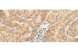 Immunohistochemistry of paraffin-embedded Human thyroid cancer tissue using NCOA4 Polyclonal Antibody at dilution of 1:130(x200) (NCOA4 anticorps)