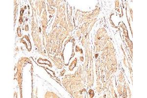 IHC: human leiomyosarcoma stained with Smooth muscle actin antibody (1A4). (Smooth Muscle Actin anticorps  (N-Term))