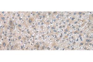 Immunohistochemistry of paraffin-embedded Human liver cancer tissue using PSMF1 Polyclonal Antibody at dilution of 1:30(x200)