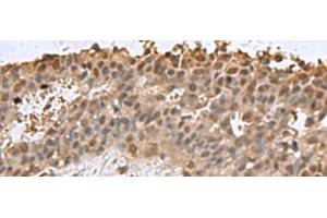 Immunohistochemistry of paraffin-embedded Human breast cancer tissue using DCTPP1 Polyclonal Antibody at dilution of 1:85(x200) (DCTPP1 anticorps)