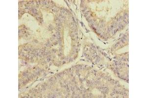 Immunohistochemistry of paraffin-embedded human endometrial cancer using ABIN7163315 at dilution of 1:100 (PLAA anticorps  (AA 536-795))