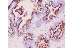 IHC-P: MUC1 antibody testing of human ovary cancer tissue