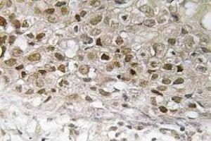 Immunohistochemistry (IHC) analyzes of p-MEK1 antibody in paraffin-embedded human breast carcinoma tissue. (MEK1 anticorps  (pThr292))