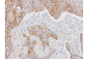 IHC-P Image Immunohistochemical analysis of paraffin-embedded HSC3 xenograft, using CD147, antibody at 1:100 dilution. (CD147 anticorps)