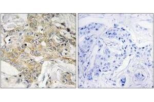 Immunohistochemistry analysis of paraffin-embedded human breast carcinoma tissue, using T4S1 Antibody. (TM4SF1 anticorps  (AA 1-50))