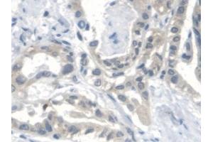 Detection of CTBS in Human Thyroid cancer Tissue using Polyclonal Antibody to Di-N-Acetyl Chitobiase (CTBS)