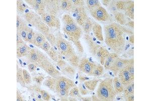 Immunohistochemistry of paraffin-embedded Human liver cancer using BLVRB Polyclonal Antibody at dilution of 1:100 (40x lens). (BLVRB anticorps)