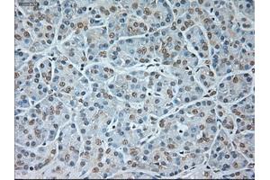 Immunohistochemical staining of paraffin-embedded Carcinoma of kidney tissue using anti-GAD1mouse monoclonal antibody. (GAD anticorps)
