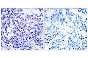 Immunohistochemical analysis of paraffin-embedded human breast carcinoma tissue using JunD(Phospho-Ser255) Antibody(left) or the same antibody preincubated with blocking peptide(right).
