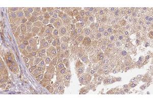 ABIN6272666 at 1/100 staining Human Melanoma tissue by IHC-P. (LTBP1 anticorps  (C-Term))
