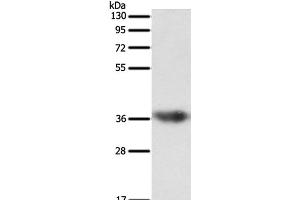 Western Blot analysis of Human liver cancer tissue using SULT1E1 Polyclonal Antibody at dilution of 1:500 (SULT1E1 anticorps)