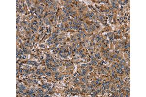 Immunohistochemistry of Human liver cancer using ETV7 Polyclonal Antibody at dilution of 1:40 (ETV7 anticorps)