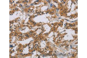Immunohistochemistry of Human brain  using IL18R1 Polyclonal Antibody at dilution of 1:40 (IL18R1 anticorps)