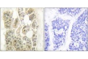 Immunohistochemistry analysis of paraffin-embedded human breast carcinoma tissue, using SSB (Ab-366) Antibody. (SSB anticorps  (AA 341-390))