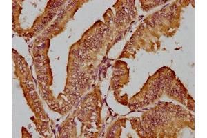 IHC image of ABIN7157154 diluted at 1:200 and staining in paraffin-embedded human endometrial cancer performed on a Leica BondTM system.