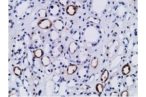Immunohistochemical staining of paraffin-embedded Human lymphoma tissue using anti-PIK3AP1 mouse monoclonal antibody. (PIK3AP1 anticorps)