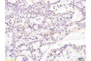 Formalin-fixed and paraffin embedded human rectal carcinoma labeled with Anti-Aldolase A Polyclonal Antibody, Unconjugated (ABIN739800) at 1:200 followed by conjugation to the secondary antibody and DAB staining (Aldolase A, Aldolase B (AA 261-364) anticorps)