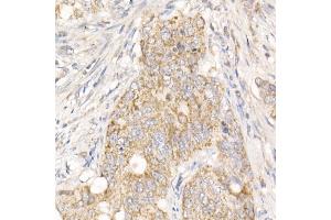 Immunohistochemistry of paraffin-embedded human colon carcinoma using PG Rabbit pAb (ABIN7269317) at dilution of 1:25 (40x lens).