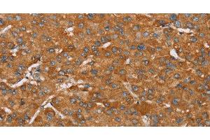 Immunohistochemistry of paraffin-embedded Human liver cancer tissue using PAGE5 Polyclonal Antibody at dilution 1:55 (PAGE5 anticorps)