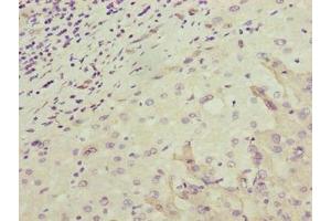 Immunohistochemistry of paraffin-embedded human liver cancer using ABIN7162175 at dilution of 1:100