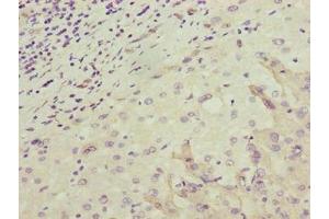 Immunohistochemistry of paraffin-embedded human liver cancer using ABIN7162175 at dilution of 1:100 (OR2H1 anticorps  (AA 157-193))