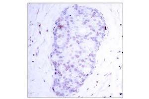 Immunohistochemical analysis of paraffin-embedded human breast carcinoma tissue using NF-κB p105/p50 (phospho-Ser907) antibody (E011019). (NFKB1 anticorps  (pSer907))