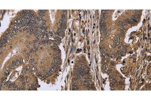 Immunohistochemistry of paraffin-embedded Human colon cancer using EIF3H Polyclonal Antibody at dilution of 1:50 (EIF3H anticorps)