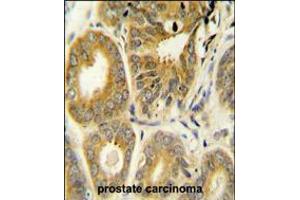 ARL8A Antibody immunohistochemistry analysis in formalin fixed and paraffin embedded human prostate carcinoma followed by peroxidase conjugation of the secondary antibody and DAB staining. (ARL8A anticorps  (AA 116-142))