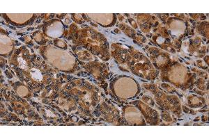 Immunohistochemistry of paraffin-embedded Human thyroid cancer using PAPPA Polyclonal Antibody at dilution of 1:50 (PAPPA anticorps)