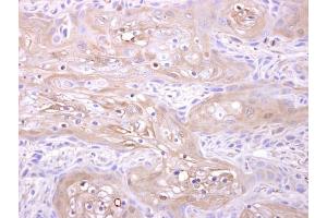 IHC-P Image Adenylate kinase 1 antibody [N1C3] detects Adenylate kinase 1 protein at cytosol on Ca922 xenograft by immunohistochemical analysis.