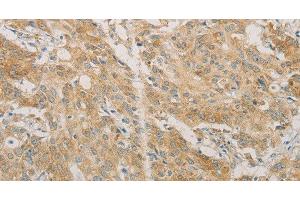 Immunohistochemistry of paraffin-embedded Human gastric cancer using ACSL4 Polyclonal Antibody at dilution of 1:60 (ACSL4 anticorps)