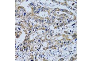 Immunohistochemistry of paraffin-embedded human colon carcinoma using TPPP3 antibody. (TPPP3 anticorps  (AA 1-176))