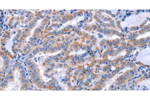 Immunohistochemistry of paraffin-embedded Human thyroid cancer using CCR6 Polyclonal Antibody at dilution of 1:50 (CCR6 anticorps)