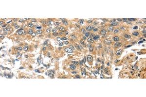Immunohistochemistry of paraffin-embedded Human esophagus cancer tissue using TTI1 Polyclonal Antibody at dilution 1:40 (TTI1 anticorps)